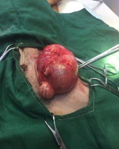 腹股沟疝气手术视频全过程,从术前准备到术后恢复